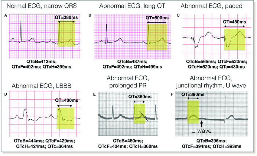 qt-interval-cardioschool